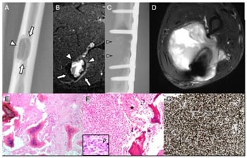Radiograph, MRI, CT and histology of low-grade central osteosarcoma with cortical involvement