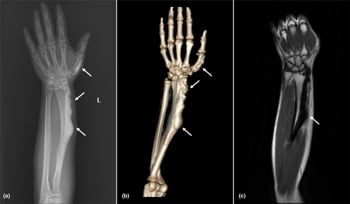 Radiograph, three-dimensional CT and MRI showing flowing cortical hyperostosis of melorheostosis