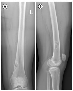 AP and lateral radiographs of an eccentric metaphyseal non-ossifying fibroma