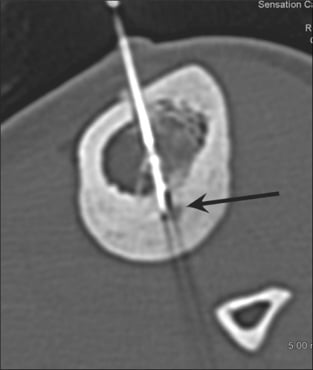 Axial CT showing a planned trans-cortical radiofrequency ablation trajectory to a tibial osteoid osteoma