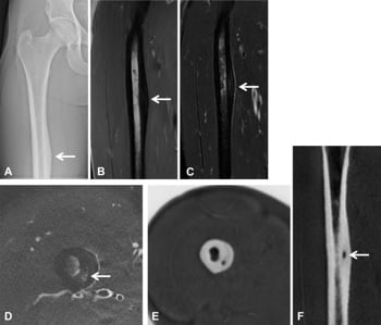 Femoral osteoid osteoma showing focal cortical thickening on radiograph, MRI oedema and a CT nidus