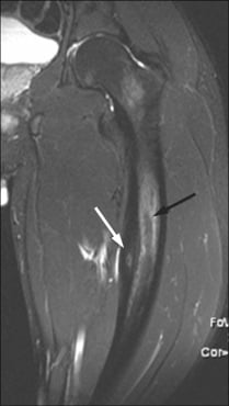 Coronal STIR MRI showing an osteoid osteoma nidus with surrounding marrow oedema