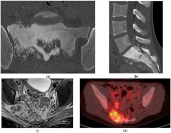 Sacral osteosarcoma showing osteoid matrix, cortical destruction and a large soft-tissue mass