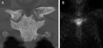 Coronal CT and bone scintigraphy showing the SAPHO bullhead sign