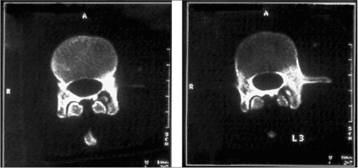 Axial CT of a vertebra with a sclerotic left pedicle containing a central nidus