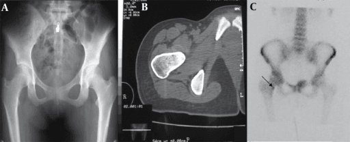 Paired hip radiograph appearing normal and CT showing a cortical sclerotic lesion with central nidus