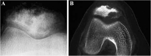 Radiograph and CT of the patella showing a mixed lytic and sclerotic lesion with ill-defined margin and cortical breach