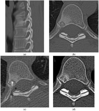 Thoracic vertebral osteoid osteoma on CT before, during and after radiofrequency ablation