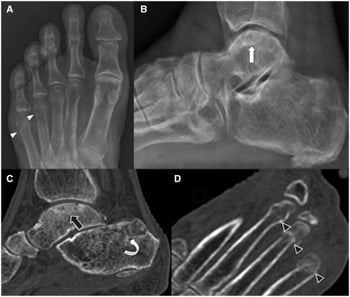 Radiographs, CT and MRI showing stress and insufficiency fractures with reactive sclerosis