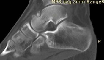 Sagittal CT showing an osteoid osteoma nidus in the talar neck