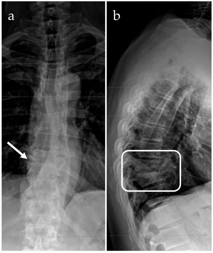 AP and lateral thoracic radiographs showing disc narrowing and adjacent vertebral collapse in spondylodiscitis