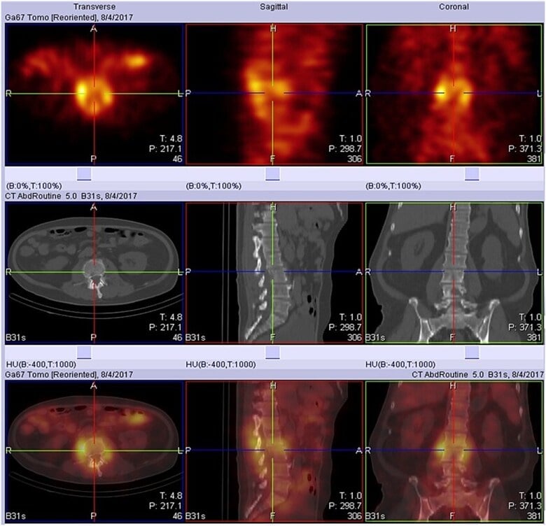 Gallium-67 SPECT-CT showing uptake at an infected L2-L3 disc and paraspinal tissues