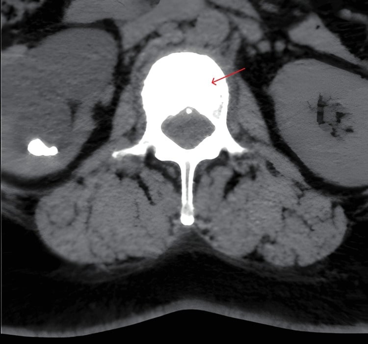 Axial CT showing homogeneous sclerosis of an ivory vertebra