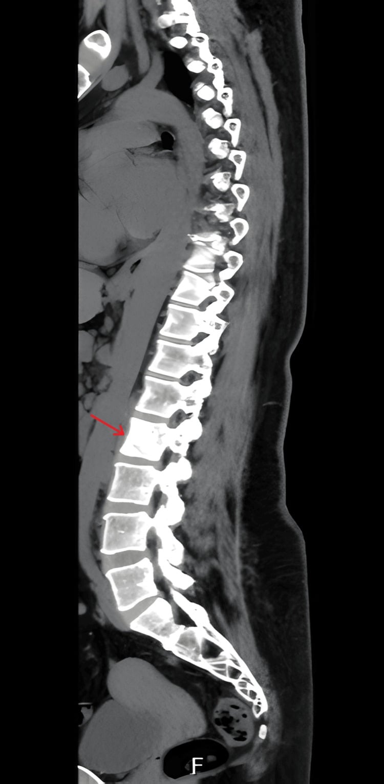 Sagittal CT showing a uniformly sclerotic L2 ivory vertebra
