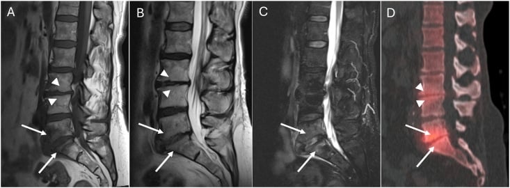 MRI and SPECT-CT showing Modic type 1 and type 2 endplate changes