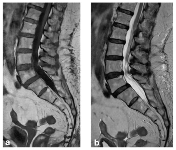 T1- and T2-weighted MRI showing Modic type 1 endplate change