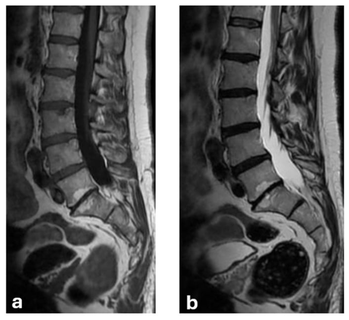 T1- and T2-weighted MRI showing Modic type 2 endplate change