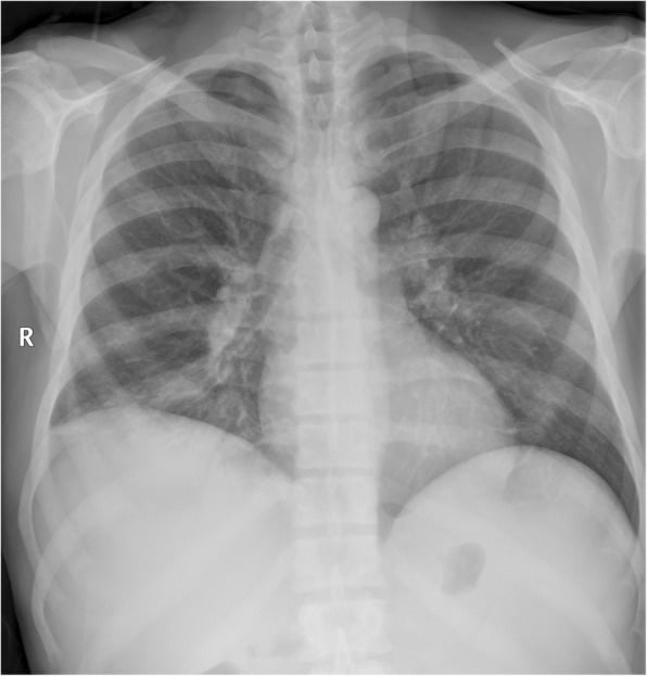 Chest radiograph showing diffuse axial osteosclerosis in myelofibrosis