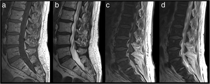 Sagittal MRI comparing normal vertebral marrow with diffuse low-signal myelofibrosis