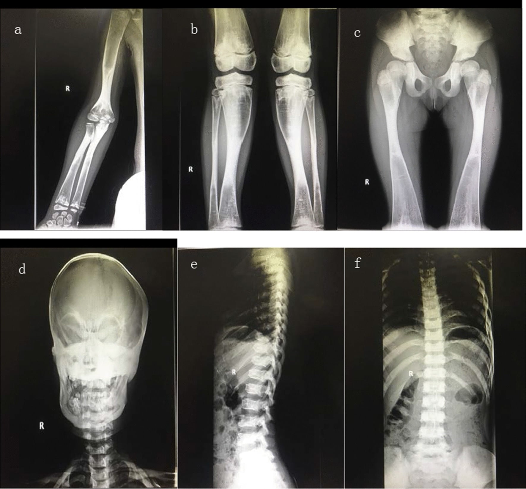 Skeletal radiographs showing diffuse osteosclerosis and sandwich vertebrae in osteopetrosis