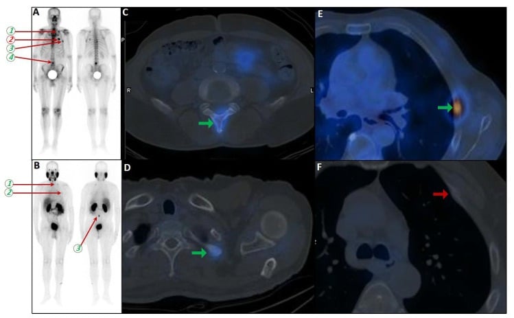Bone scan and PSMA SPECT-CT showing concordant L5 vertebral metastasis