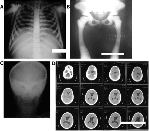 X-ray and CT images of the spine and ribs showing thickened, dense vertebral endplates with sandwich-like appearance.