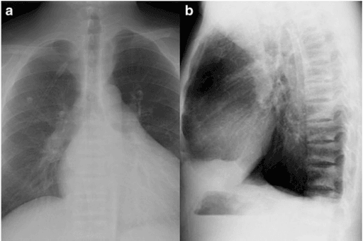 Chest X-rays in two projections showing dense horizontal bands along vertebral endplates with lucent central vertebral bodies.