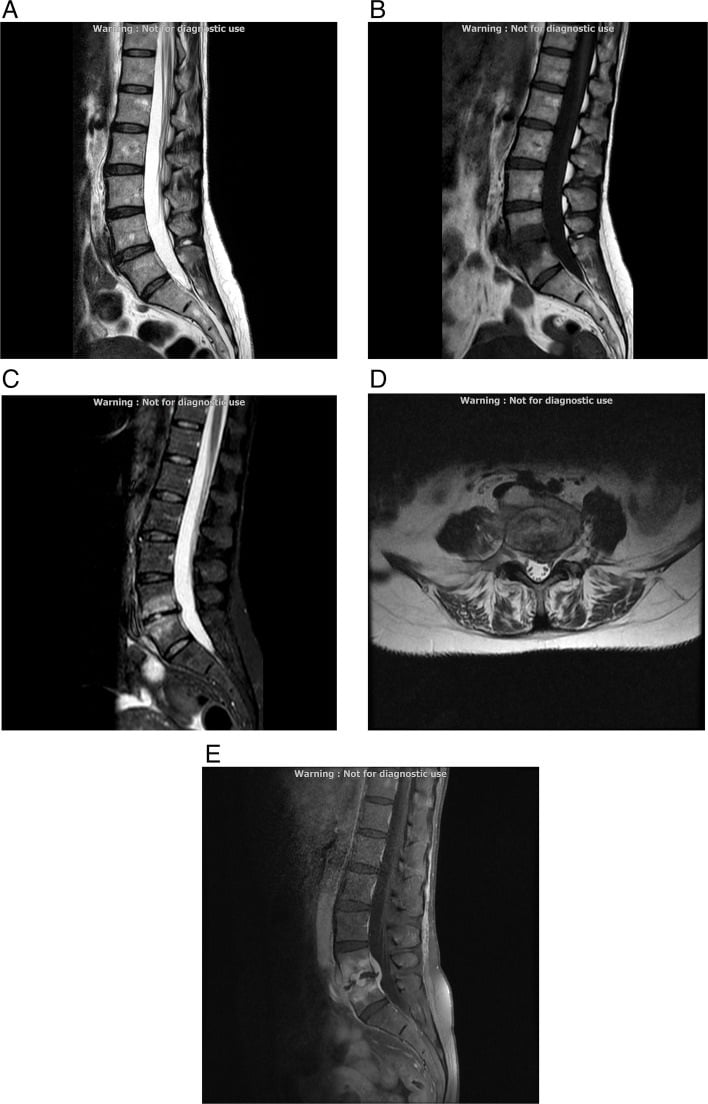 Serial lumbar MRI showing development of L5-S1 infectious spondylodiscitis