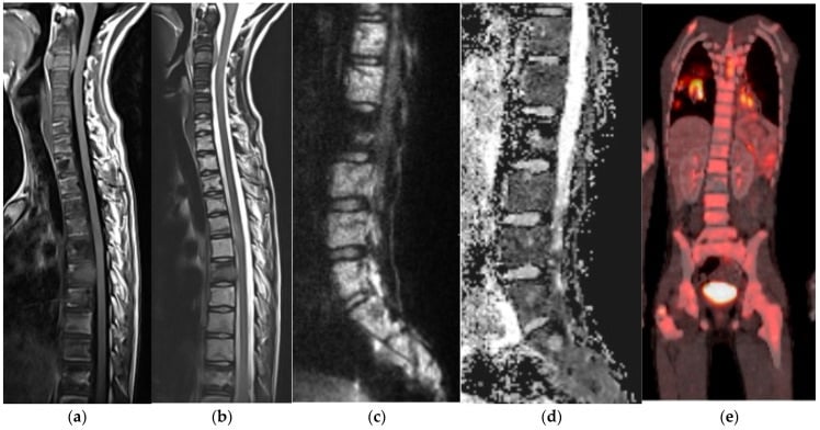 Sagittal MRI showing extensive vertebral marrow infiltration by lymphoma