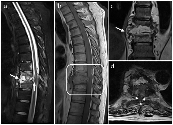 Multiplanar MRI showing endplate destruction, disc infection and epidural abscess