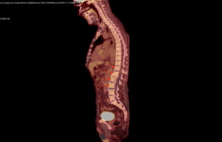 FDG PET showing multiple non-avid sclerotic vertebral lesions in systemic mastocytosis