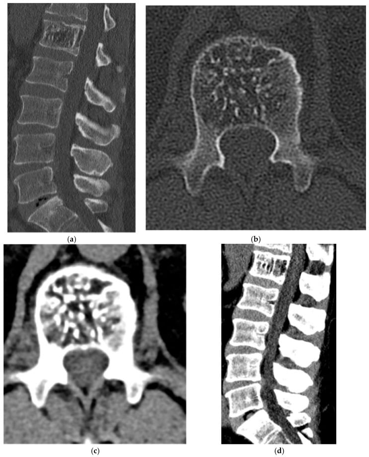 CT and MRI showing corduroy and polka-dot signs of vertebral haemangioma