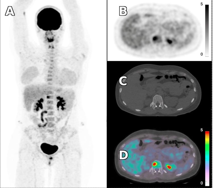 FDG PET-CT localising a metabolically active T12 vertebral lesion