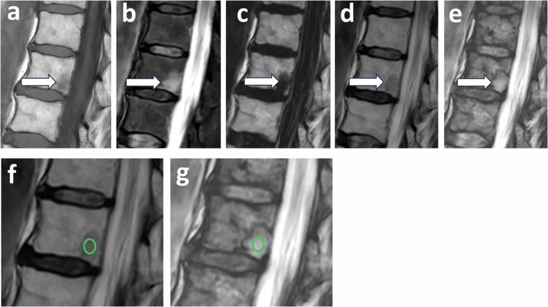 Multiparametric MRI showing vertebral metastasis distinct from benign marrow hyperplasia