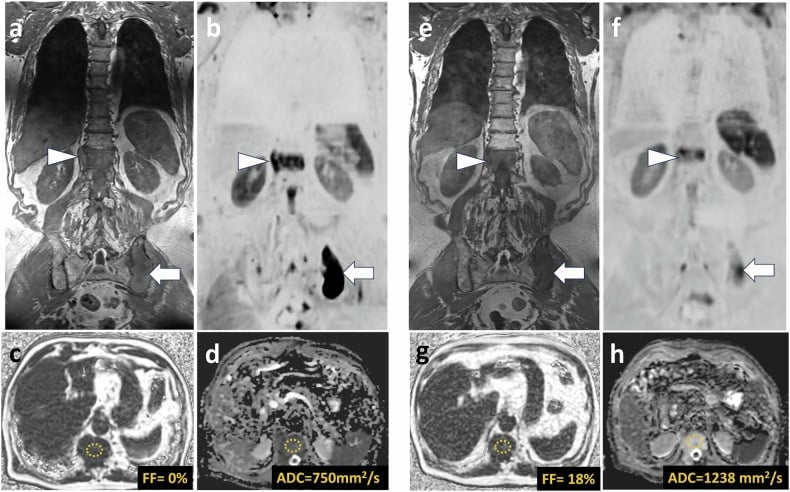 Whole-body MRI showing multifocal marrow disease at diagnosis and after treatment