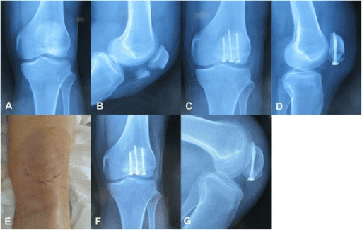 AP and lateral radiographs showing percutaneous cannulated screw fixation of a transverse patellar fracture, with an anterior knee incision photograph