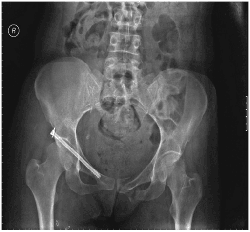 AP pelvis radiograph after percutaneous fixation of a right anterior-column acetabular fracture with a cannulated screw