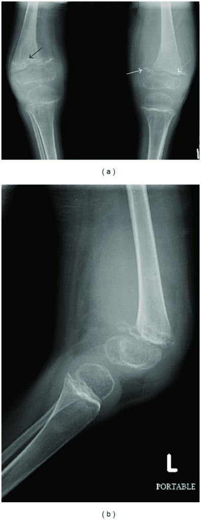 AP and lateral knee radiographs showing classic scurvy features