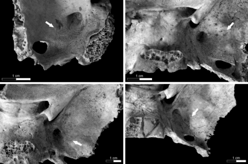 Examples of new bone formation around the foramen rotundum in a 3 year old child (upper left), 7–8 year old child (upper right), 5–6 year old child (lower left), and a 1–2 year old child (lower right)