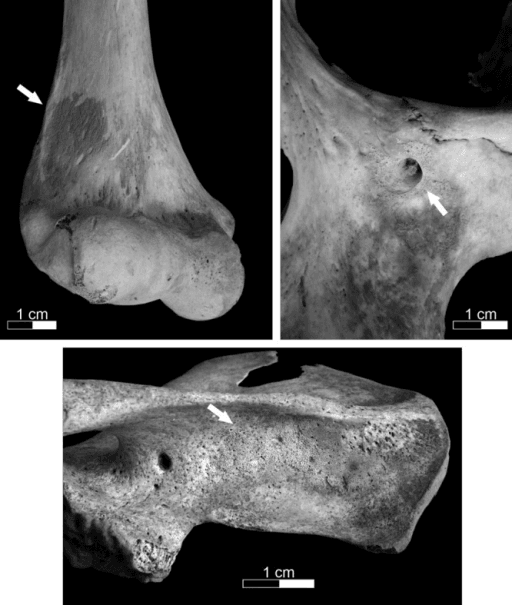 New bone formation on the distal humerus (18–25 year old male) (upper left), the infraorbital foramen (26–35 year old female) (upper right), and the supraspinous area of a right scapula (7–8 year old