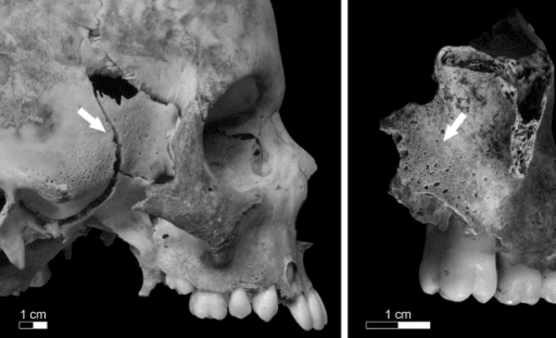 Example of definite diagnostic scorbutic traits—porotic lesions to the greater wing of the sphenoid (10–11 year old child) (left) and porous bone formation on the posterior surface of the maxillary bo
