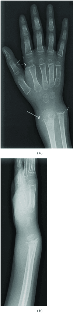 AP and lateral wrist radiographs showing scurvy features including Wimberger ring