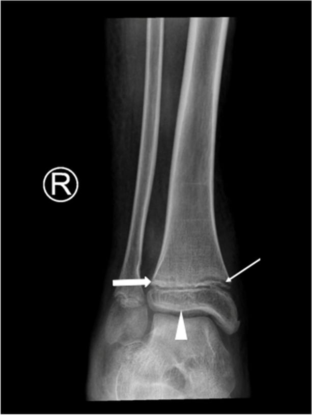 Right ankle radiograph with a thick arrow on the Frankel line, an arrowhead on the Wimberger ring and a thin arrow at the metaphyseal margin