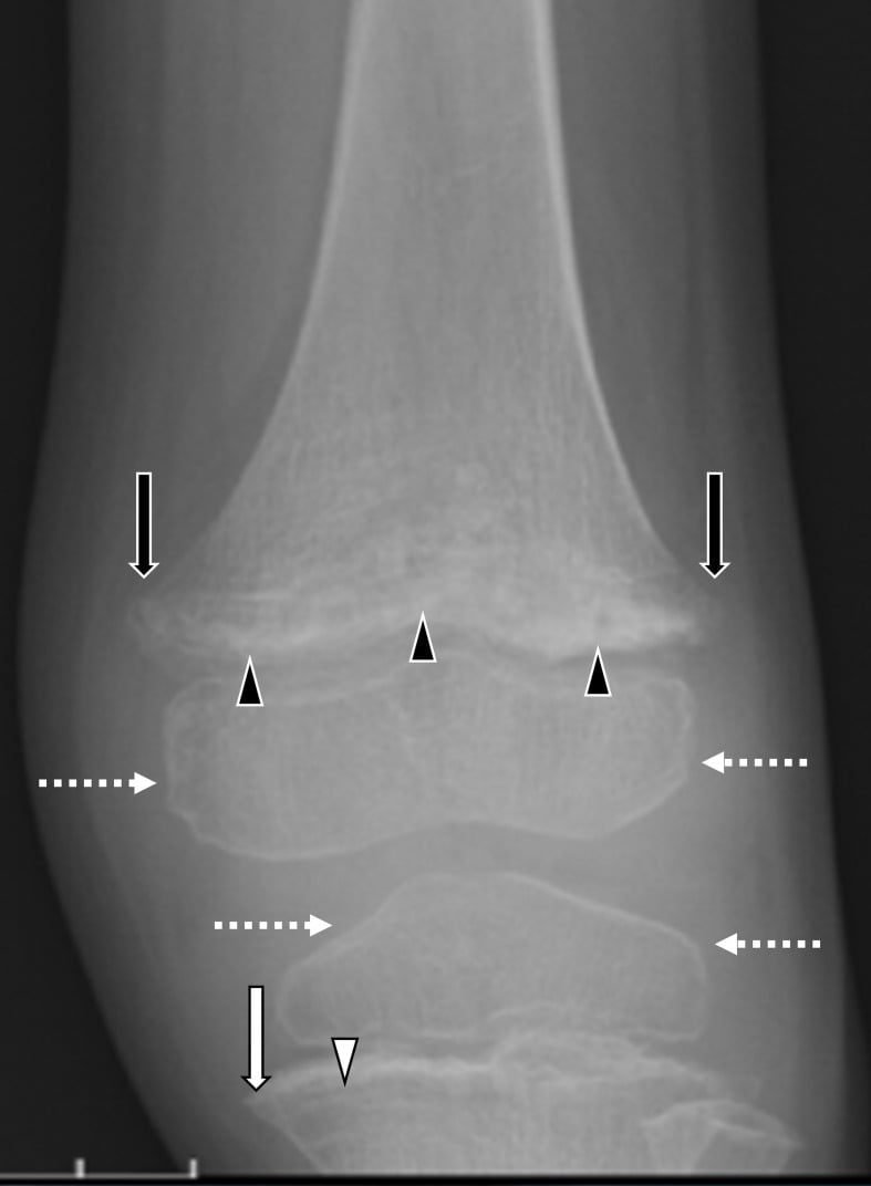 Frontal knee radiograph of a child with arrows and arrowheads marking femoral Pelkan spurs, the growth plate, the tibial Frankel line and a lucent scurvy line, and dotted arrows at the dense epiphyseal rims