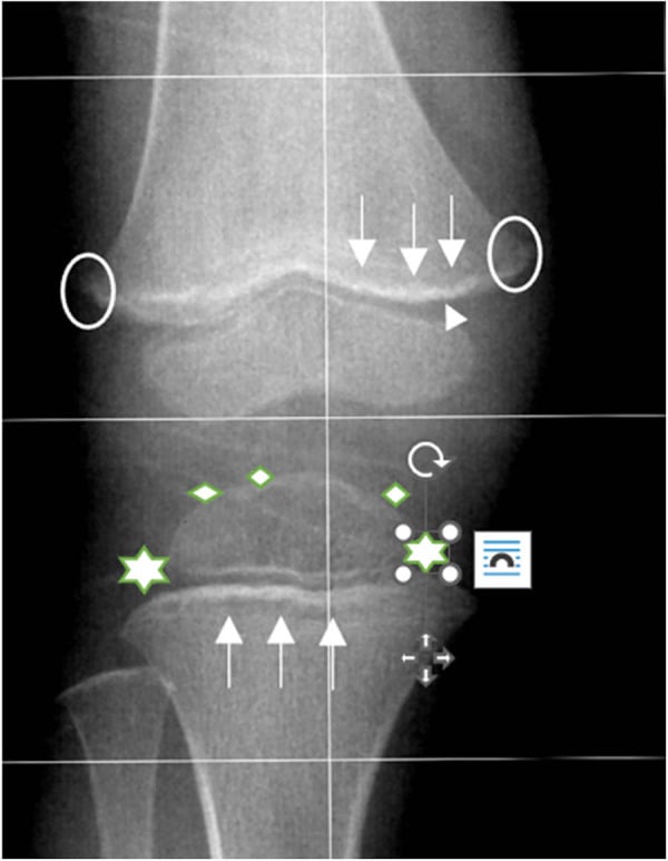 Annotated knee radiograph with an arrowhead, arrows, circles, diamonds and stars marking the Frankel line, Trümmerfeld zone, Pelkan spurs and Wimberger ring of scurvy