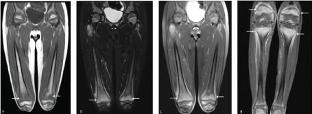 Four coronal MRI panels of the lower limbs showing bilateral distal femoral metaphyseal and subperiosteal signal abnormality in early scurvy