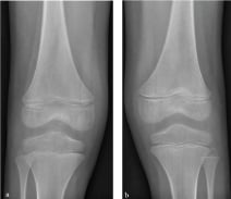 Two knee radiographs, panels a and b, appearing normal in early paediatric scurvy