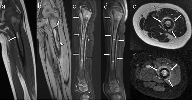 Six-panel femoral MRI with asterisks on abnormal marrow signal and arrowheads at a haemosiderin rim on the coronal T2* image and arrows at marrow and periosteal enhancement on axial images