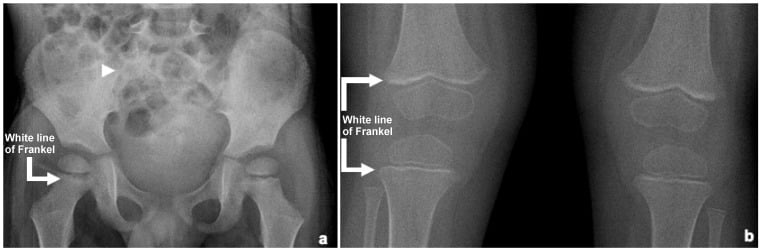 Pelvis radiograph (a) and knee radiographs (b), each with the white line of Frankel labelled at the proximal femoral and peri-knee metaphyses