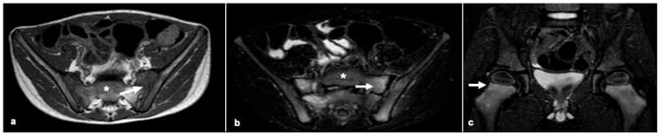 Axial pelvic and coronal hip MRI showing signal abnormality at the sacroiliac region and proximal femoral metaphysis in scurvy